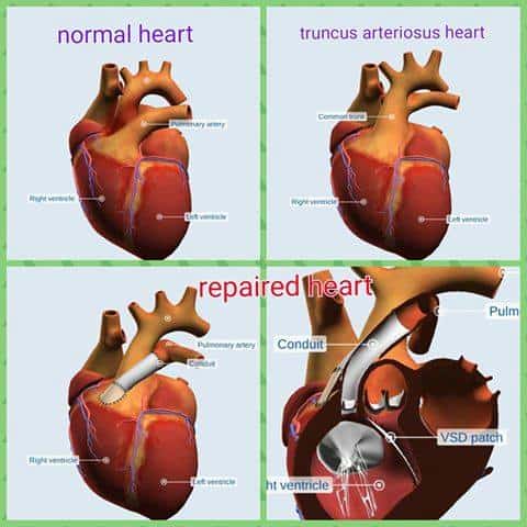 fixed heart